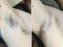 脱毛サロン ベル(Bell)/しっかり効果！ツルツルお肌◎