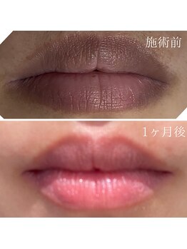 ソルテシュガーリング(SORTE sugaring)/ローマピンク 黒ずみ除去