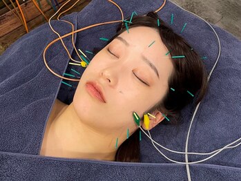 ビースタイル(B-style)の写真/リフトアップ低周波美容鍼で頬・目元のたるみケア＆ほうれい線を撃退！更にむくみ解消でスッキリ小顔へ☆
