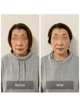 チル(Chill.)/美容整体×小顔整顔でリフトUP！