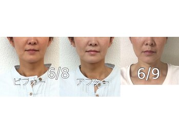 ビューティスタジオＫ/小顔矯正ビフォーアフター