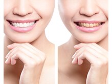 宮崎セルフホワイトニング/もう一度体験してみたいお客様