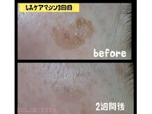 ドルチェヴィータ(DOLCE VITA)/しみケア　低周波ペンシル