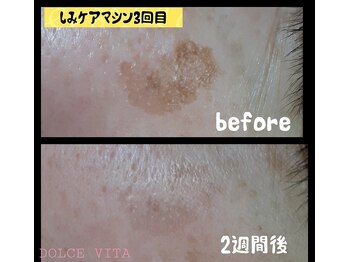 ドルチェヴィータ(DOLCE VITA)/しみケア　低周波ペンシル