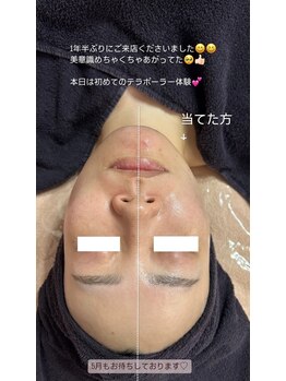 スピカ(Spica)/spicaの小顔フェイシャル