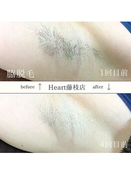 ハート 藤枝店(Heart)/脇脱毛 CLEAR/SP