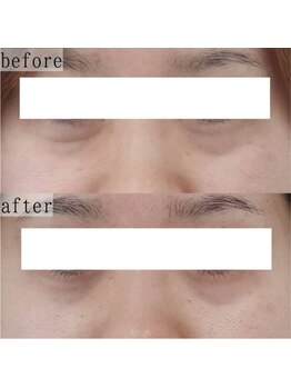 ヴェルシック(Belchic)/自信の持てる目元へ変化