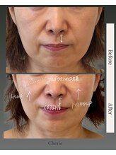 シェリー(Cherie)/60代のたるみ /人中/ハリ不足