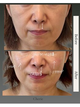 シェリー(Cherie)/60代のたるみ /人中/ハリ不足