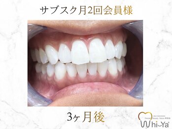 ホワイヤ セルフホワイトニング DBS神楽坂(Whi-Ya)/☆サブスク会員様☆納得の白さ☆