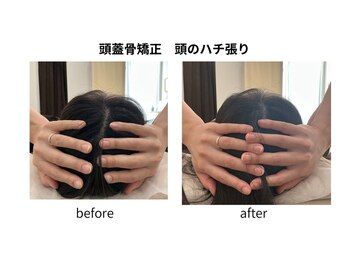 ブライト鍼灸整体院(Bright鍼灸整体院)/美容鍼　小顔矯正