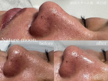ナチュールムーン(Nature moon.)/毛穴洗浄
