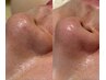 【毛穴ケア】開き毛穴にも対応◎毛穴レスの肌へ