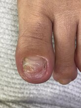 フットメンテ 巻き爪矯正センター 南浦和/肥厚爪　初回施術後
