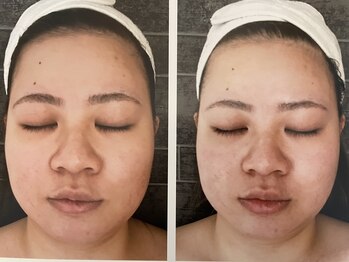 ダルセーニョ/コルギ施術１回目　Before-After