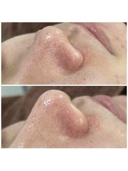 アイリーン(IRENE)/毛穴洗浄の効果実感♪