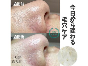 リッカロッカ(RIKKA&ROCCA)/今日から変わる毛穴ケア