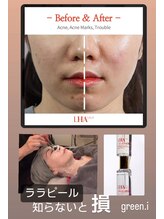 エステティックサロン グリーンアイ 浦和店(green.i)/ララピール／小顔/たるみ/毛穴