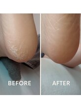 ワイグレイス(Y.GRACE)/フットケア《角質ケア》