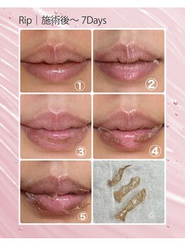 テセラ(TESELA)/【ローマピンク】唇/リップ/経過