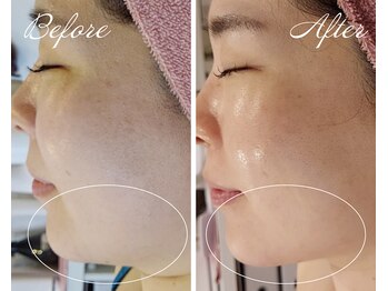 ミセル(MISEL2nd)/ シュっとした輪郭に★小顔ケア