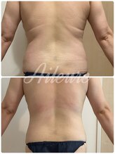 エルール トータルビューティ(Aileure total beauty)/インディバ痩身