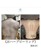 サロンドシェリ(salon de cheri)/ハーブピーリング