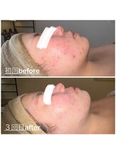 ミニョン(mignon)/肌質変化してきたかも！