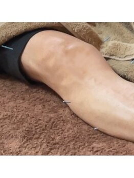 狭山池尻みやび鍼灸マッサージ院/脚のむくみ対策に