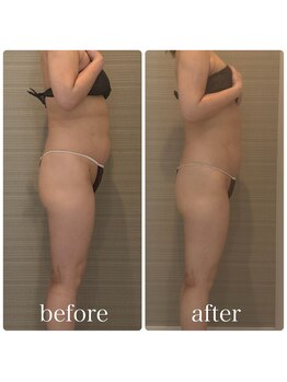 ブリス(BLiSS)/月1ペースで♪