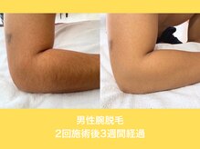 エクレ 柏店(EKURE)/メンズ腕脱毛