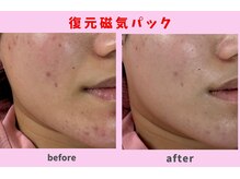 20代女性ニキビや跡を気にされて磁気パック1回の施術です。