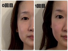 キプラ 福津店(KIPURA)/小顔矯正1回目