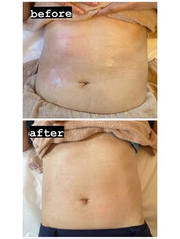 ルルン(LuLuN)/ラジオ波痩身お腹まわり