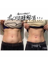 OBS新潟整骨院/脂肪冷却でポッコリお腹解消