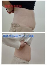 縁(en)/脂肪冷却