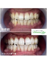 ホワイトニングサロン 名古屋駅店/【ホワイトニング施術例】