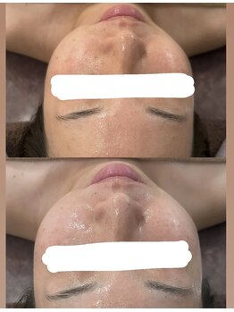 温オン(ON)/セルマンフェイシャル☆