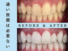 ホワイトニングショップ 浦和店/ホワイトニングビフォーアフター