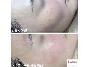 シミケア専門サロン Lotus. 千早香椎店【シミ/シワ/毛穴/小顔】/シミケア4回目