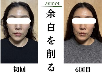 asmot鍼灸 整体院 代々木上原(asmot鍼灸 整体院)/【代々木上原】食いしばり美容鍼