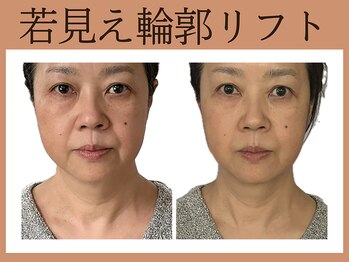 サロン オリ(salon_oli)の写真/【加齢のサインは輪郭が原因!?】輪郭リフト×最新ハーブピーリングで若見えフェイスラインが叶う☆八戸