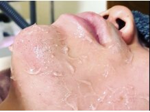 サンライズ ワックス(Sunrise Wax)/ヒゲ脱毛