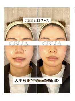 セリア(CELIA)/小顔矯正