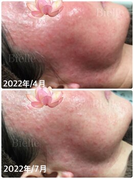 ビエル(Bielle)/かんぽう、ひふかでも改善しない