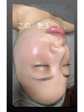 エステティックサロン グリーンアイ 浦和店(green.i)/小顔/たるみ/毛穴／レモンボトル