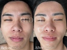 ムーム なんば店(moom)/美容男子がするフェイシャルMENU