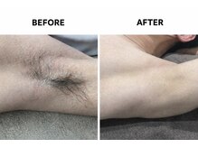 自由が丘ダツモウセンター(自由が丘 DATSUMOW CENTER)/両脇脱毛～男性～