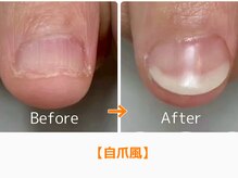 レアム/120分後には人工爪が完成します