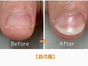 レアム/120分後には人工爪が完成します